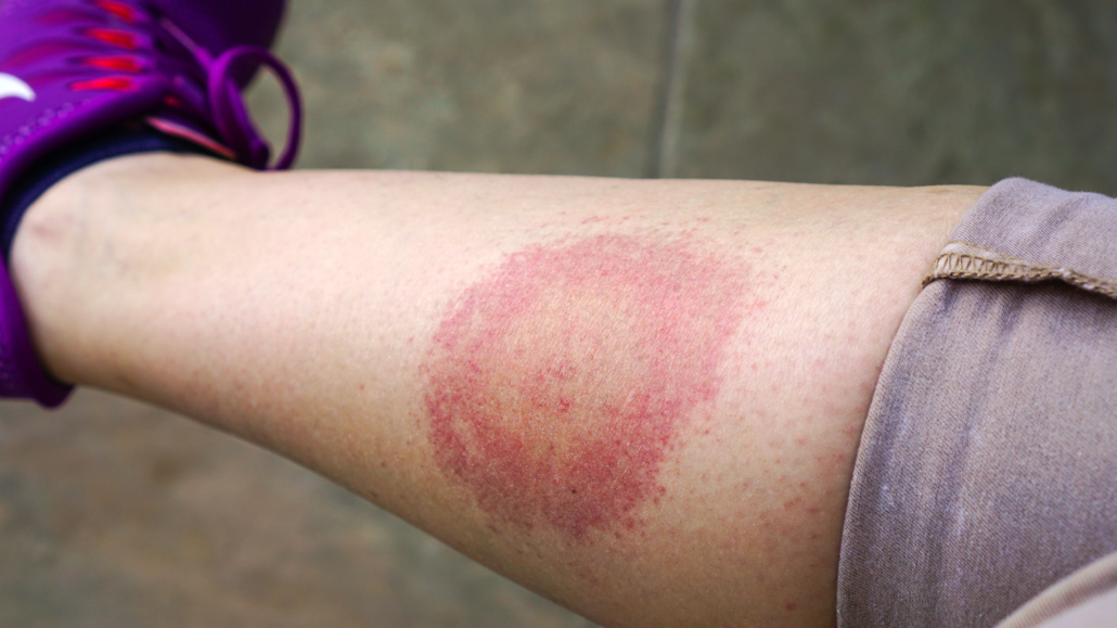 Lyme Disease Tick Bite Rash