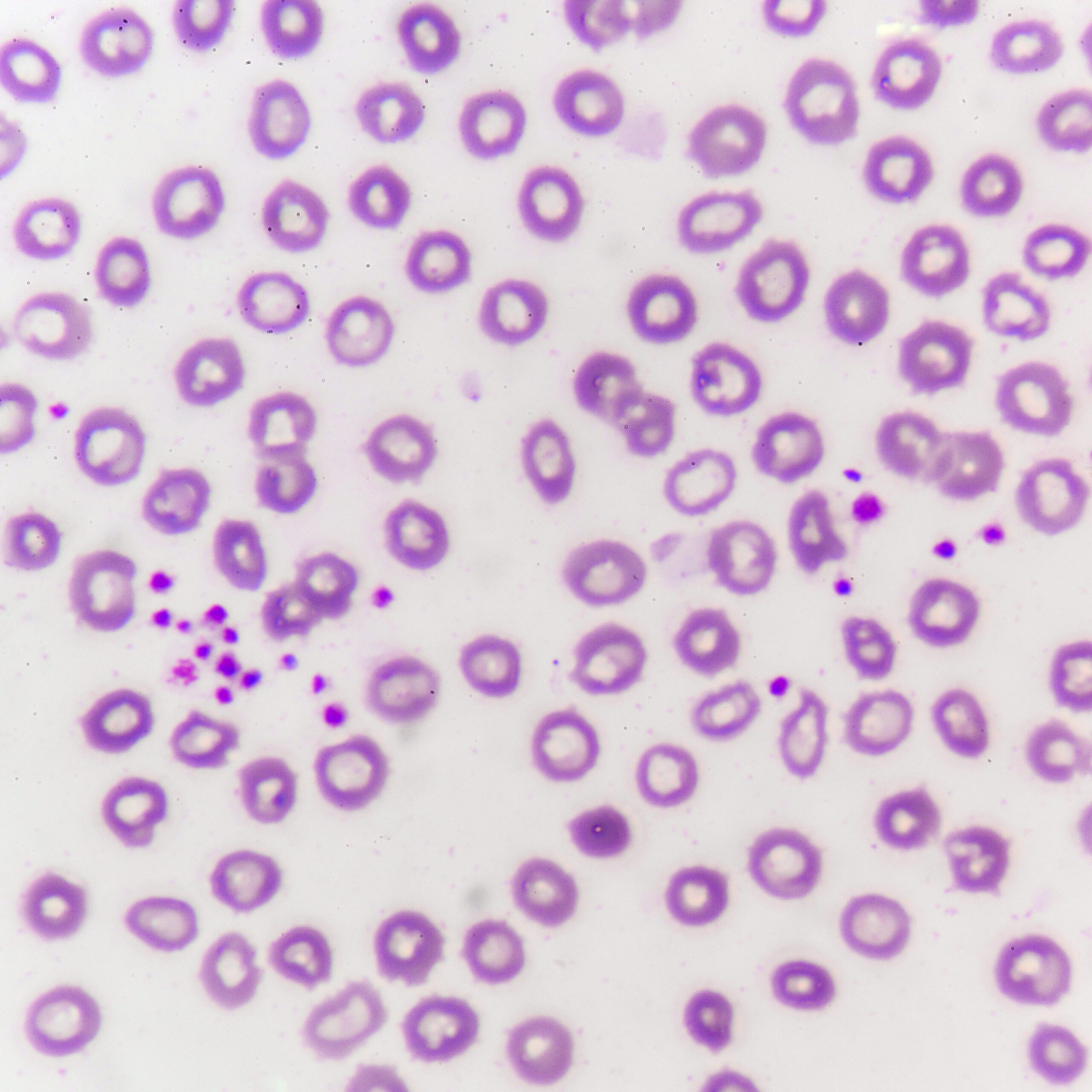 Platelet Rich Plasma Therapy